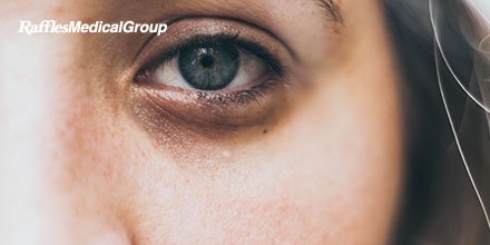 Are dark eye circles always due to #fatigue? Not necessary, it can also be due to #allergies or #pigmentation irregularities.

#eyecircles #darkeyecircles #lifestyle