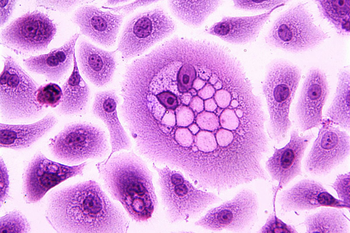 ACTforCancer's tweet photo. Clear, accurate and accessible advice is essential to ensuring everyone has the best chance against cancer. The HPV vaccine is just such an example. #cancer #HPV #vaccine #SexEd #health #women #cervicalscreening #NHS #actforcancer #knowledge #smart #virus https://t.co/4aTieJ6Bgt https://t.co/5hJVKT3O1Y