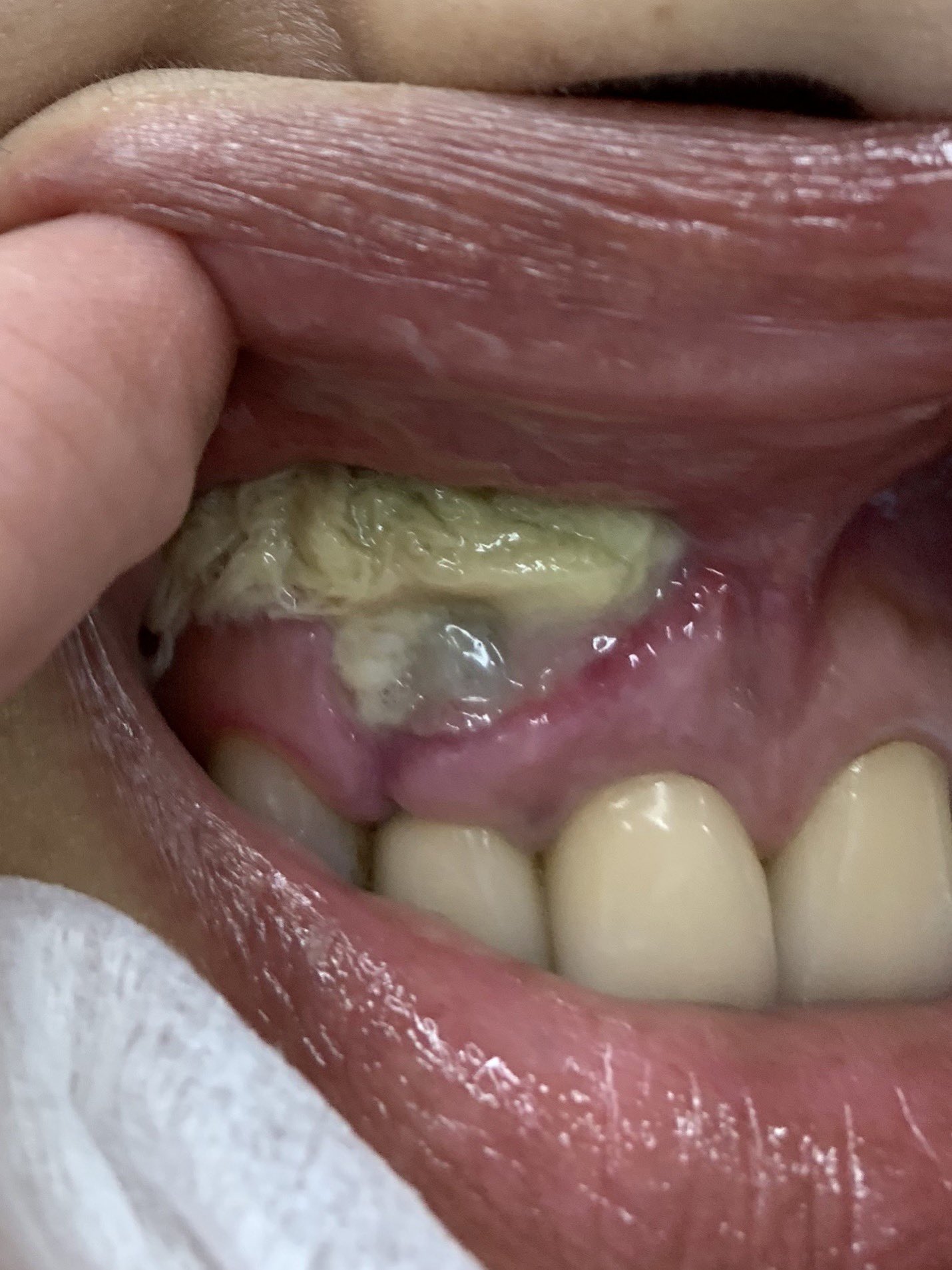 大原ひろゆき やさしい歯科医師 歯を抜かないほうがいい いわれますが 抜かなくていい歯はもちろん抜く必要ないものの 重度の歯周病や根の先の病気の歯をずっと置いておくのはまずいです すごく腫れが出たり 嚢胞という大きな膿の袋ができたり