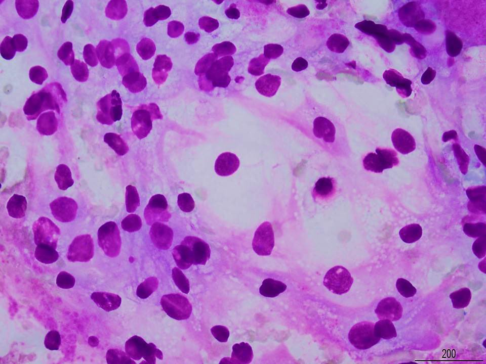 SamKhader's tweet photo. #FNA #biopsy from a kidney mass in a patient with extensive #lymph_node metastasis. The #IHC stains are positive for PAX-8, RCC, and CD10, while negative for CK7 and CK20. The findings are c/w classic (conventional) renal cell carcinoma. @SaeedAsiry @Mycytopathology #CytoPath https://t.co/EwaNI5zCxR