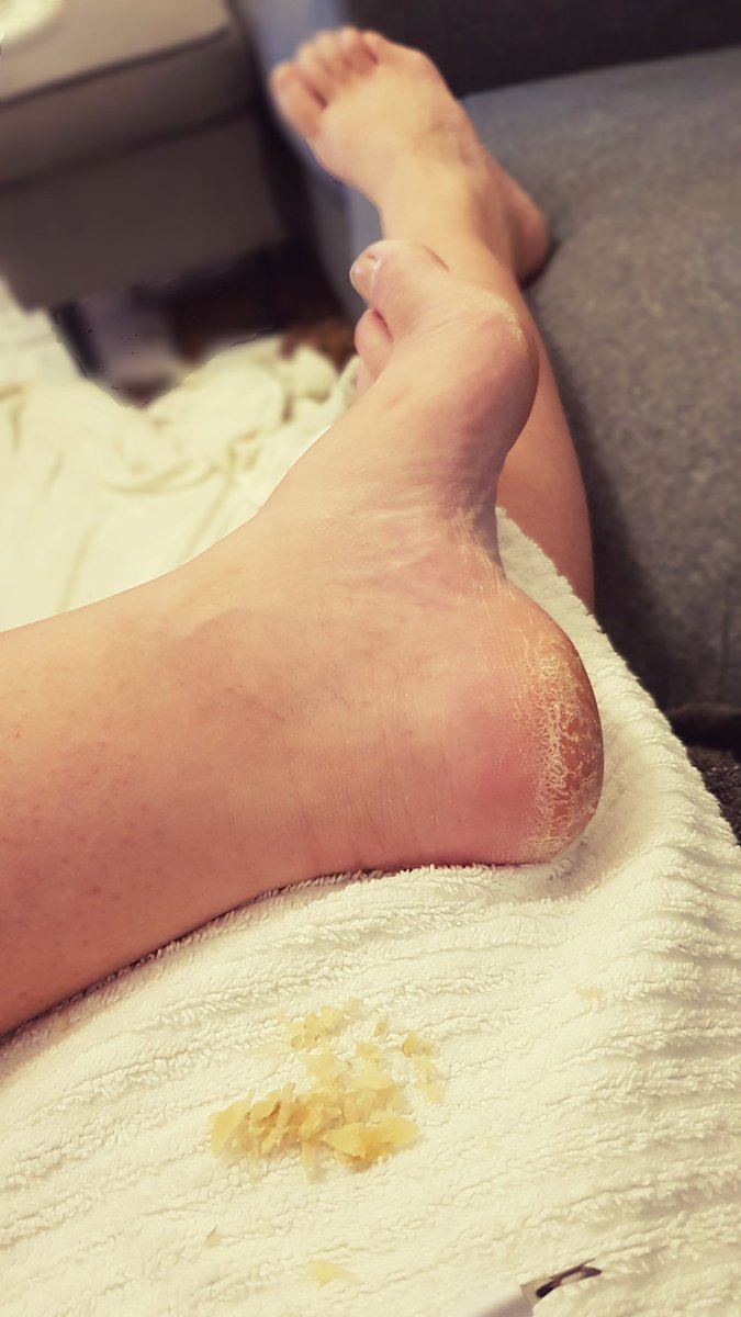 TheLadyQual's tweet photo. Pampering after a fantastic month of beaches, barefoot hikes, &amp; flip flop strolls through Italian towns. 

You know you want it.

#findom #findom #outdoorfeet #barefeet #footdust #footshavings #dirtyfeet #footfetısh #footfetishnation #footwaste 
@RTCuck @rt_feet @FootParadiseRT https://t.co/jgv4eNAq2C