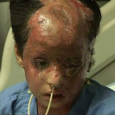 YemenEye1's tweet photo. Wrenching, sad!
Saudis to be using US-supplied white phosphorus in war in Yemen. When a shell explodes, the chemical inside reacts w/ air, creating burning cloud. When the cloud comes into contact w/ flesh it maims, burns lungs, &amp; kills. To use this in populated areas is a crime. https://t.co/3BgWZmCDD5