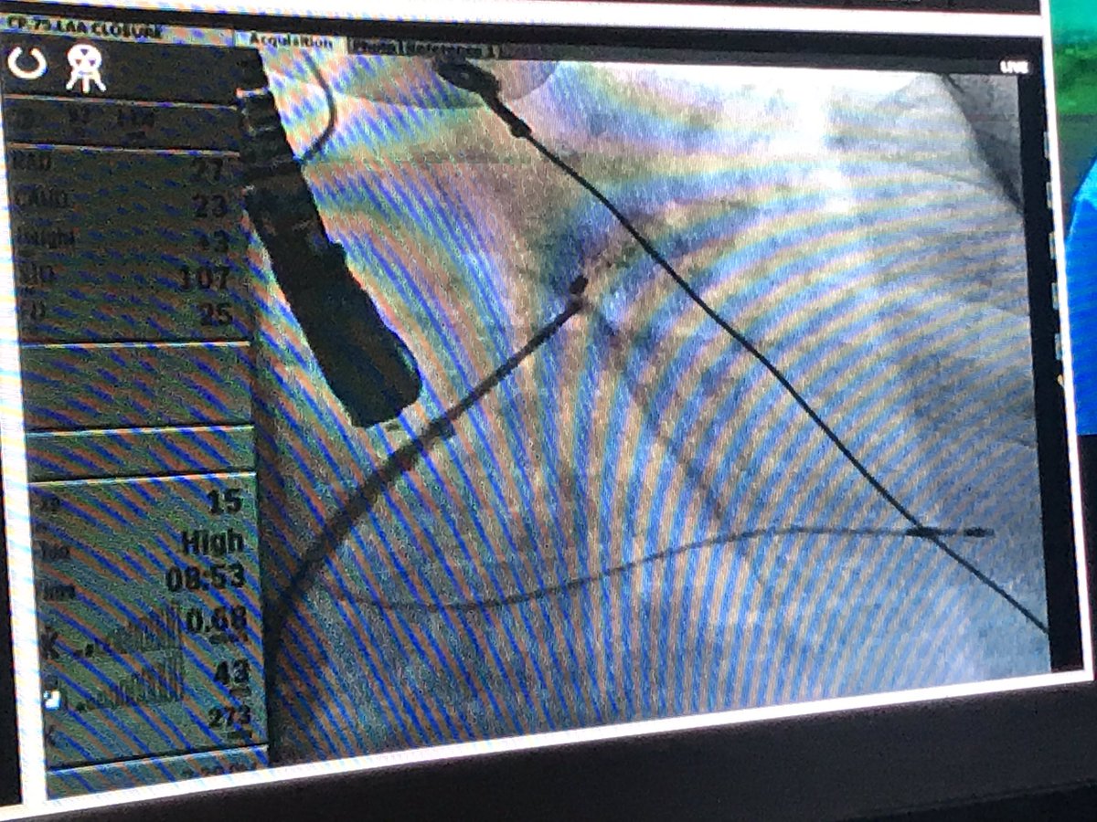 epliveindia's tweet photo. A unique experience of an array of LAAO device implantation done under one roof at #epliveindia2019 #watchman #acp #lambre @DJ_Lakkireddy @aalahmadmd @HRSonline @manak_18 @psharmadoc @ACCinTouch @andreanatalemd @DrSaxenaAnil https://t.co/WhLvoMSg9z