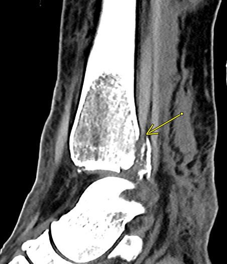 KhuranaBharti's tweet photo. Posterior tibialis tendon-DON'T get trapped  #radres please pay attention to tendons on CT when you are reporting fractures #FOAMrad #FOAMed #MSKrad #EMrad #MSKErad #orthopedics #trauma  @MKMSKER @ASER_ERad https://t.co/PnYhR0qjem
