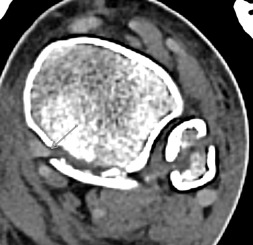 KhuranaBharti's tweet photo. Posterior tibialis tendon-DON'T get trapped  #radres please pay attention to tendons on CT when you are reporting fractures #FOAMrad #FOAMed #MSKrad #EMrad #MSKErad #orthopedics #trauma  @MKMSKER @ASER_ERad https://t.co/PnYhR0qjem