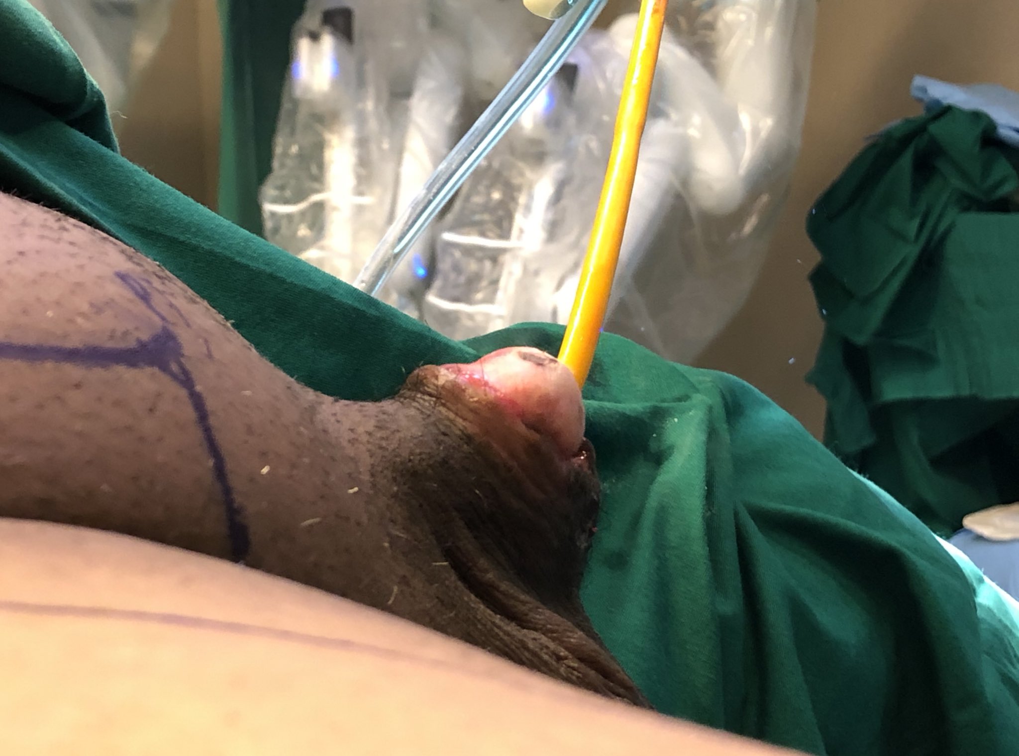 Penectomy twitter ❤️ Best adult photos at gayporn.id