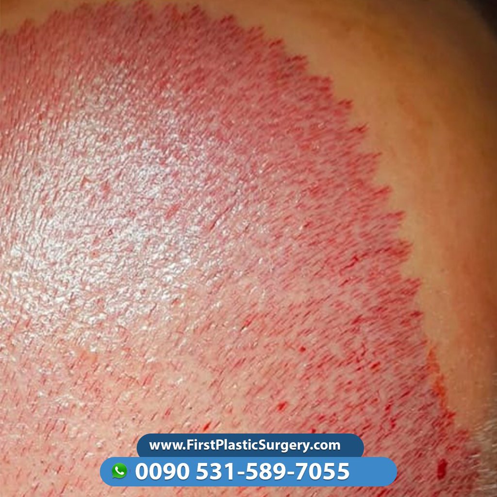 CosmeticsTurkey's tweet image. Picking the perfect hair transplant #clinic can be a tough decision. #First_plastic_surgery in Turkey can be one of your top #hair_transplant clinics depending on treatments, services and costs

WhatsApp:📱
00905315897055

#hairstyle
#9agosto
#80euro
#senzaPerdere
#DiMaio
#Flat