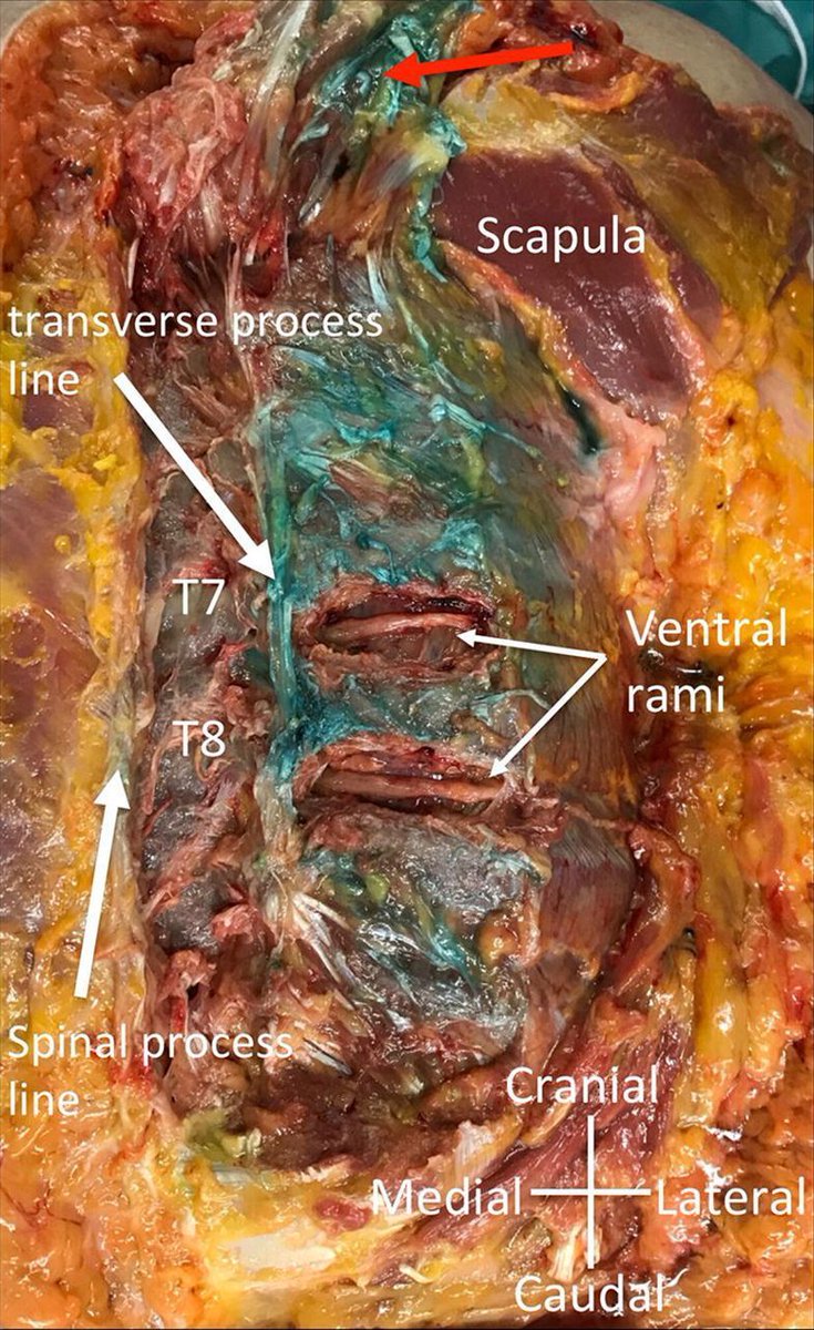 CJA_Journal's tweet image. Anatomical evaluation of the extent of spread in the #erectorspinae plane block

"After a T7 ESP injection in cadavers, diffusion of dye &amp;amp; contrast was seen only at the posterior rami not the paravertebral space.

 buff.ly/32BYOIB #ESPblock #RegionalAnesthesia #CJA