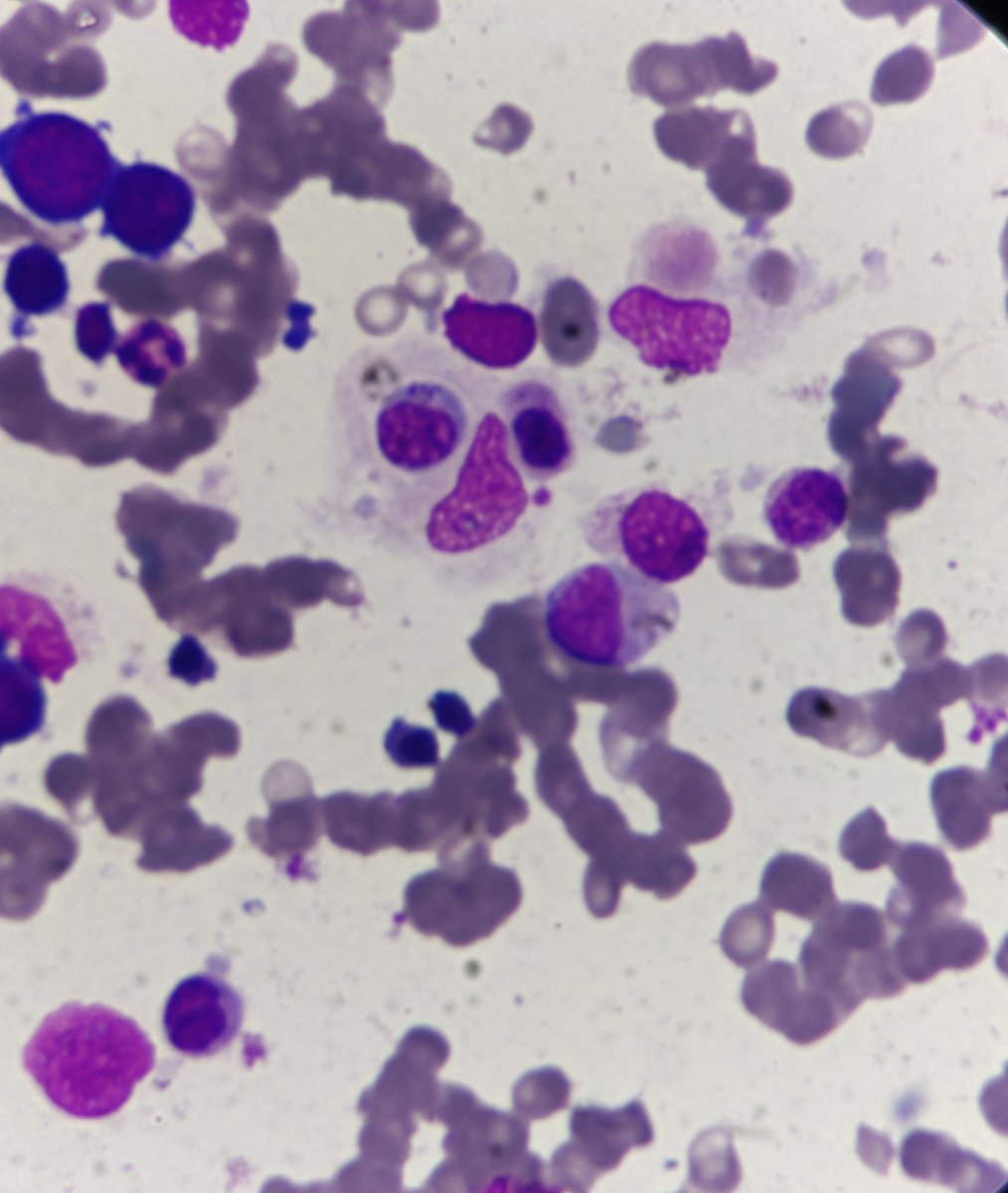 # pathology # hematology Young male with fever, cytopenias, hepatosplenomegaly and ferritin of 14000. Beautiful hemophagocytosis in the bone marrow