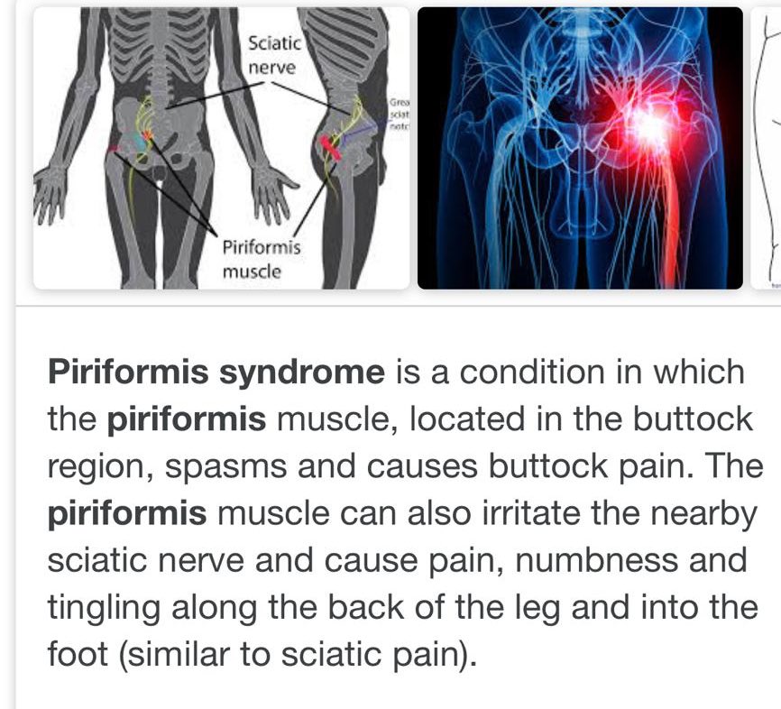 First little #run in weeks today - sore, finally getting some #acupuncture to try and solve this frustrating ongoing issue...any advise appreciated. Tried a foam roller, and rest..#runninginjury #fintness @runners_blue @PolSportGwent