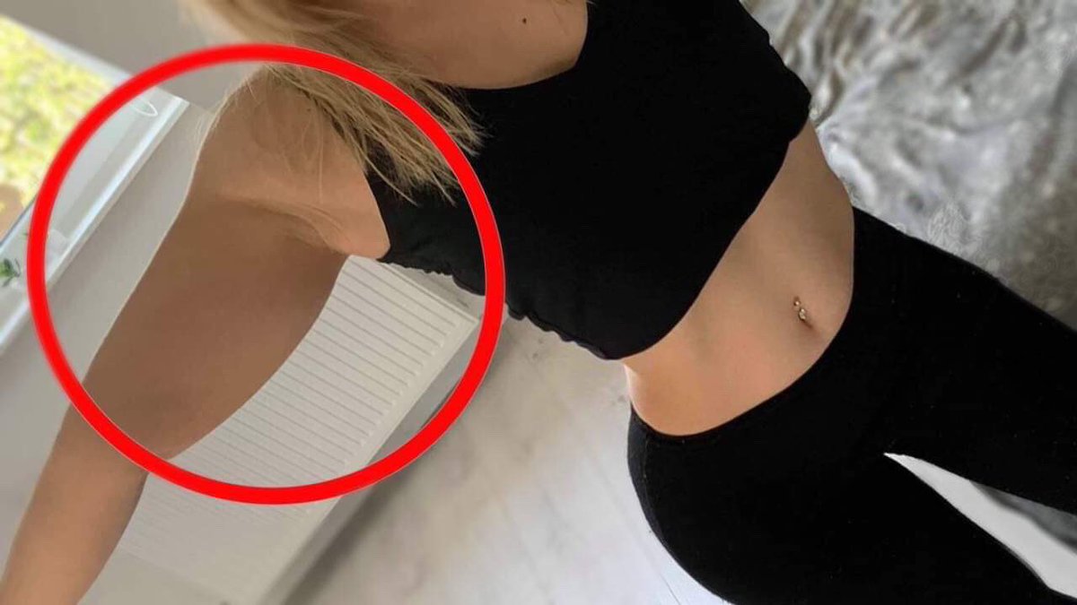 EmmyMakeUpPro's tweet photo. Lipoedème : maladie des gros bras ! N’hésitez pas à RT pour m’aider à faire connaître ma maladie. 1 femme sur 10 de touchées en France 😪https://t.co/JcEDUidDVt https://t.co/bgxEAdJtm1