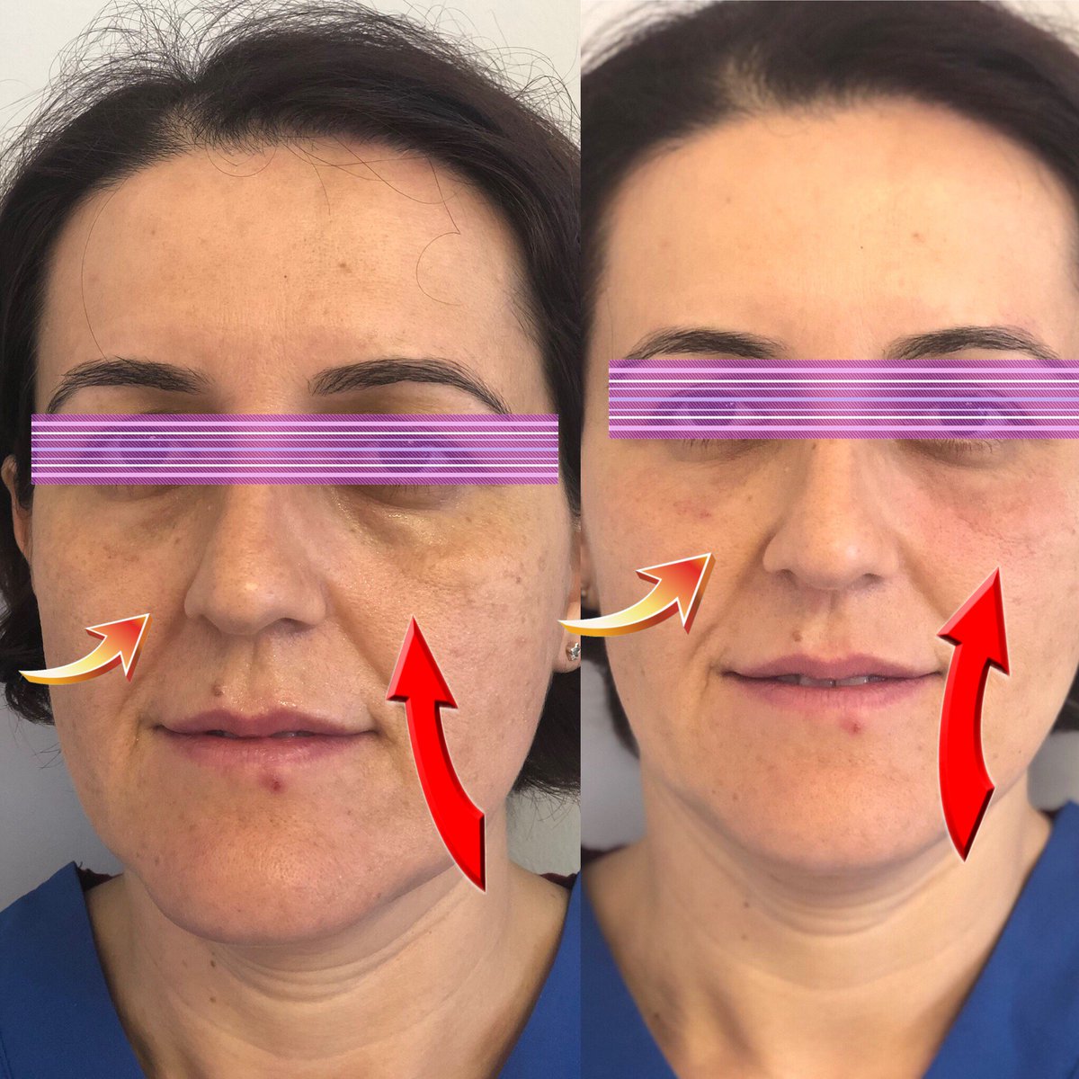 Göz altı çukurları yorgun ve yaşlı gösterebiliyor. Düzeltmek için sadece PRP ve kremler yetmeyebilir. Juvederm ile yaptığımız güzel bir sonucu sizinle paylaşmak istedik. #tearthroughfiller #gözaltıdolgusu #juvederm #allergan