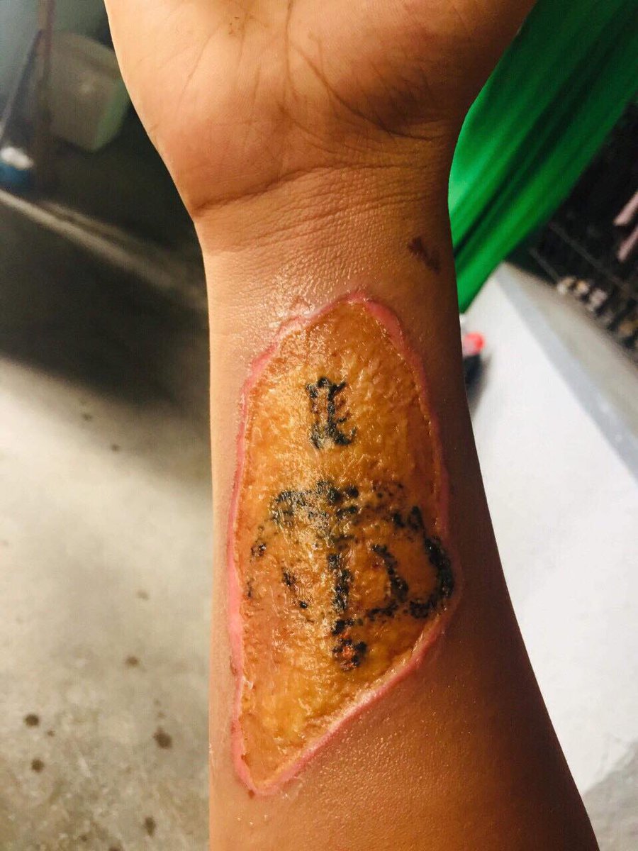 gmanews's tweet photo. Dahil sa hindi inirerekomendang paraan ng pagtanggal ng tattoo, ito ang nangyari kay "Eugene." #KMJS https://t.co/z7KVY1cRF6