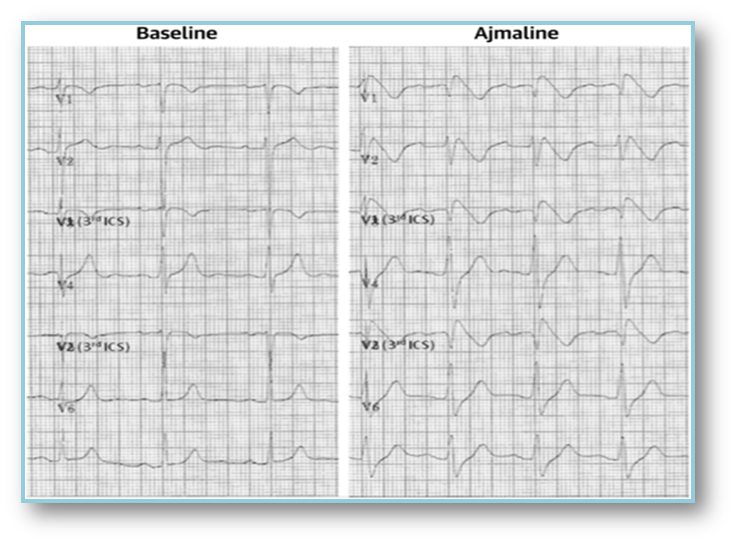 #brugadasyndrome core #EP and provocation testing.
#EPeeps #Cardiology #cardiotwitter 
#fellowsfirst