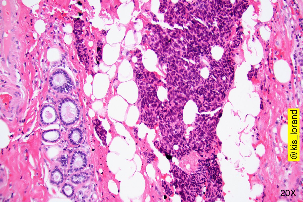 kis_lorand's tweet photo. Breast lumpectomy with the following histology...Any thoughts? 
#breastpath #pathology #IHCpath https://t.co/8ssRbTZes4
