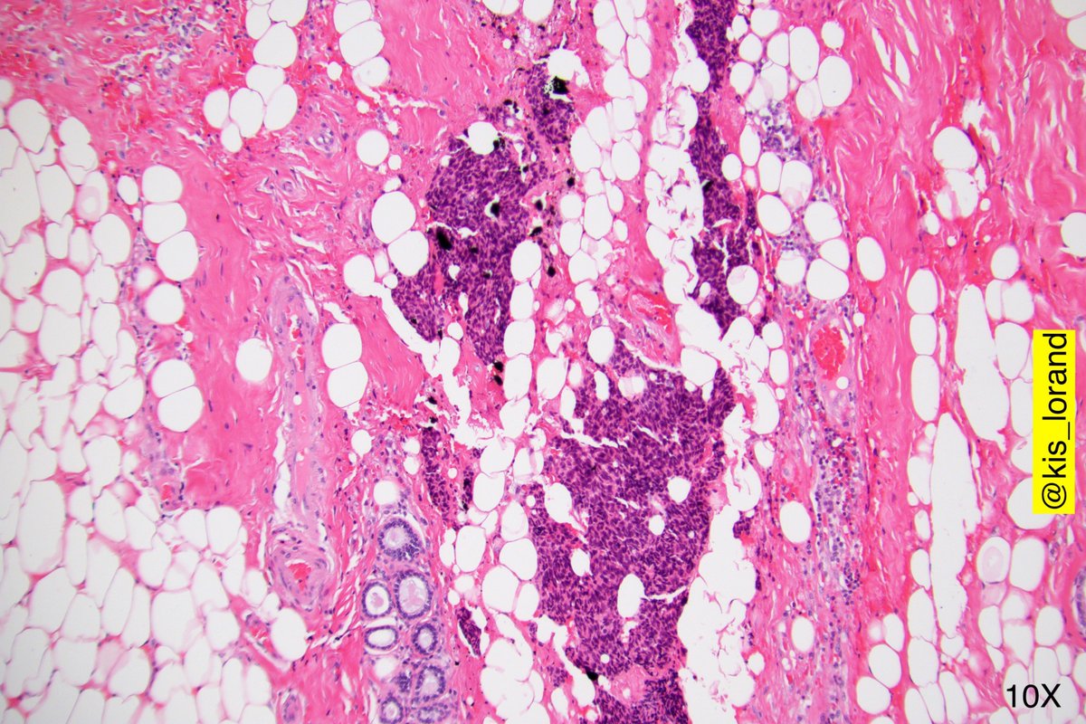 kis_lorand's tweet photo. Breast lumpectomy with the following histology...Any thoughts? 
#breastpath #pathology #IHCpath https://t.co/8ssRbTZes4