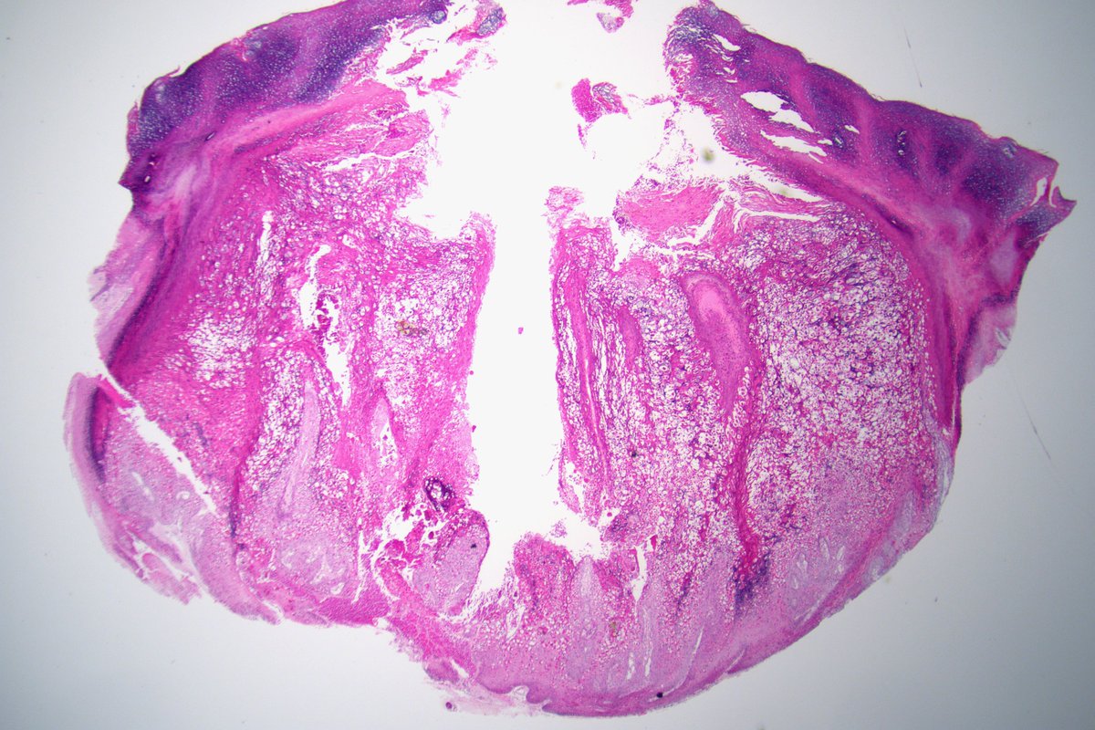 kis_lorand's tweet photo. It is rainy season...with eosinophilic granules 😂
#dermpath https://t.co/0Ip1xq2l6X
