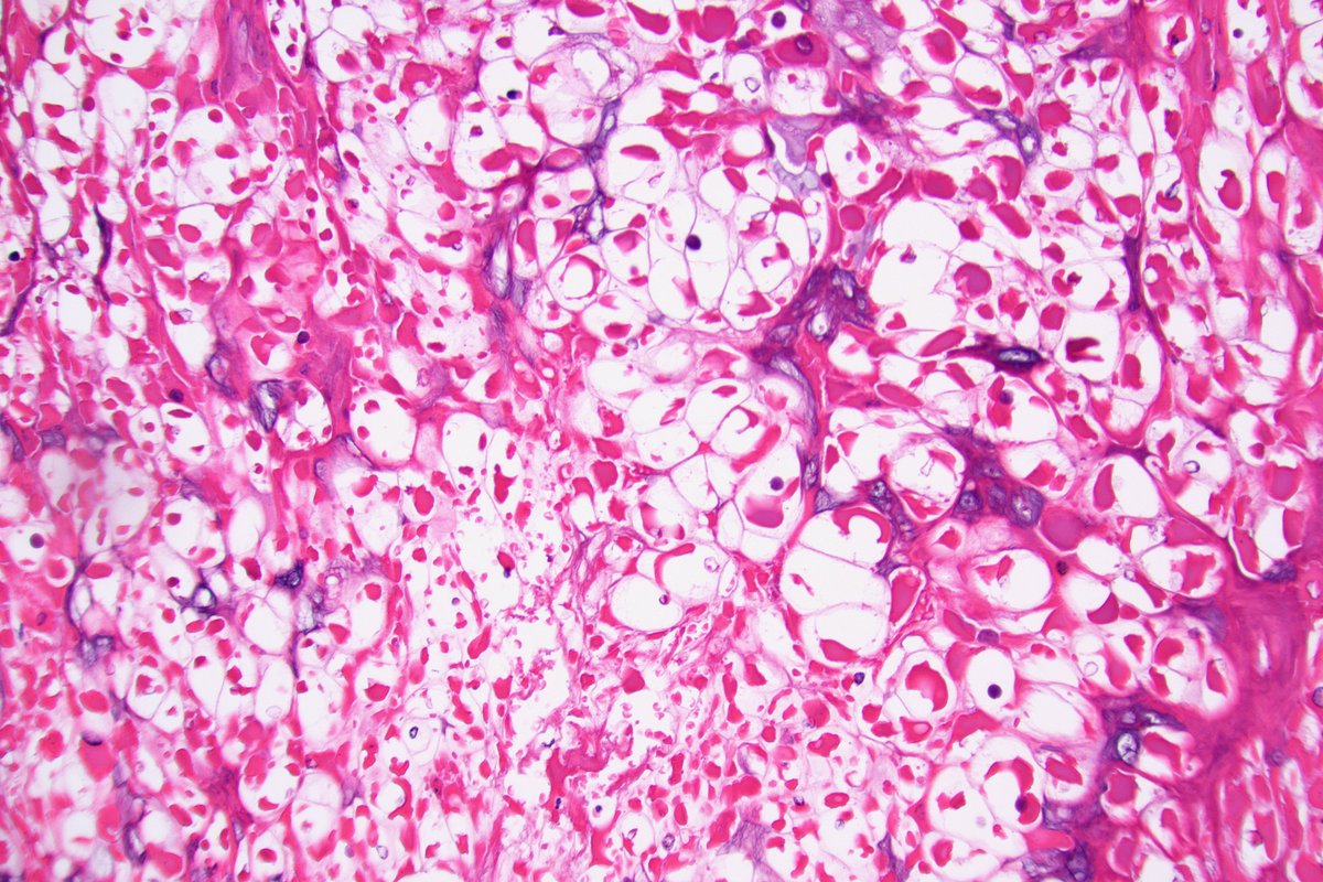 kis_lorand's tweet photo. It is rainy season...with eosinophilic granules 😂
#dermpath https://t.co/0Ip1xq2l6X