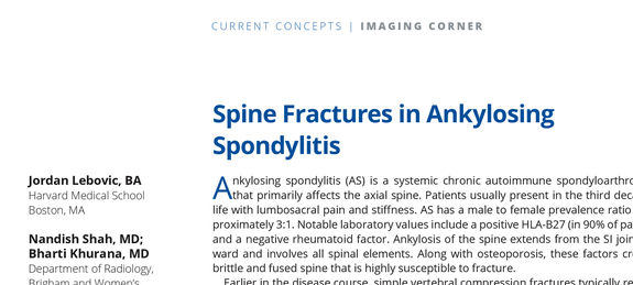 KhuranaBharti's tweet photo. Kudos to Jordan Lebovic, #medstudent @harvardmed & Nandish Shah #radres @BWHRadEdu, future #MSKfellow @nyu_mskrad for their work in #Spineline @NASSspine on fractures in #ankylosingspondylitis @ASER_ERad @nyu_mskrad #spine https://t.co/ZpanQzoeHt