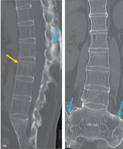 KhuranaBharti's tweet photo. Kudos to Jordan Lebovic, #medstudent @harvardmed & Nandish Shah #radres @BWHRadEdu, future #MSKfellow @nyu_mskrad for their work in #Spineline @NASSspine on fractures in #ankylosingspondylitis @ASER_ERad @nyu_mskrad #spine https://t.co/ZpanQzoeHt
