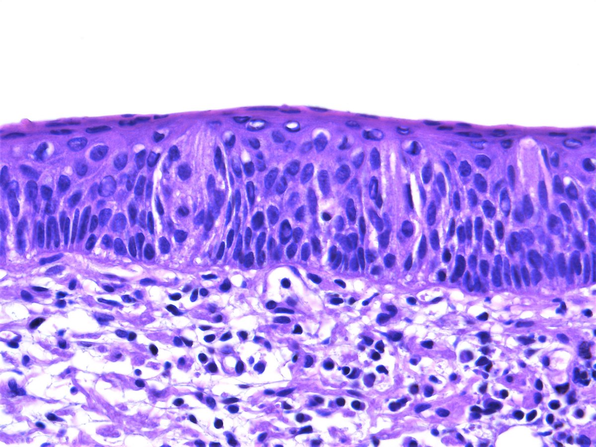 Taste buds seen in normal tongue. #Histology #Oralpath #Pathology