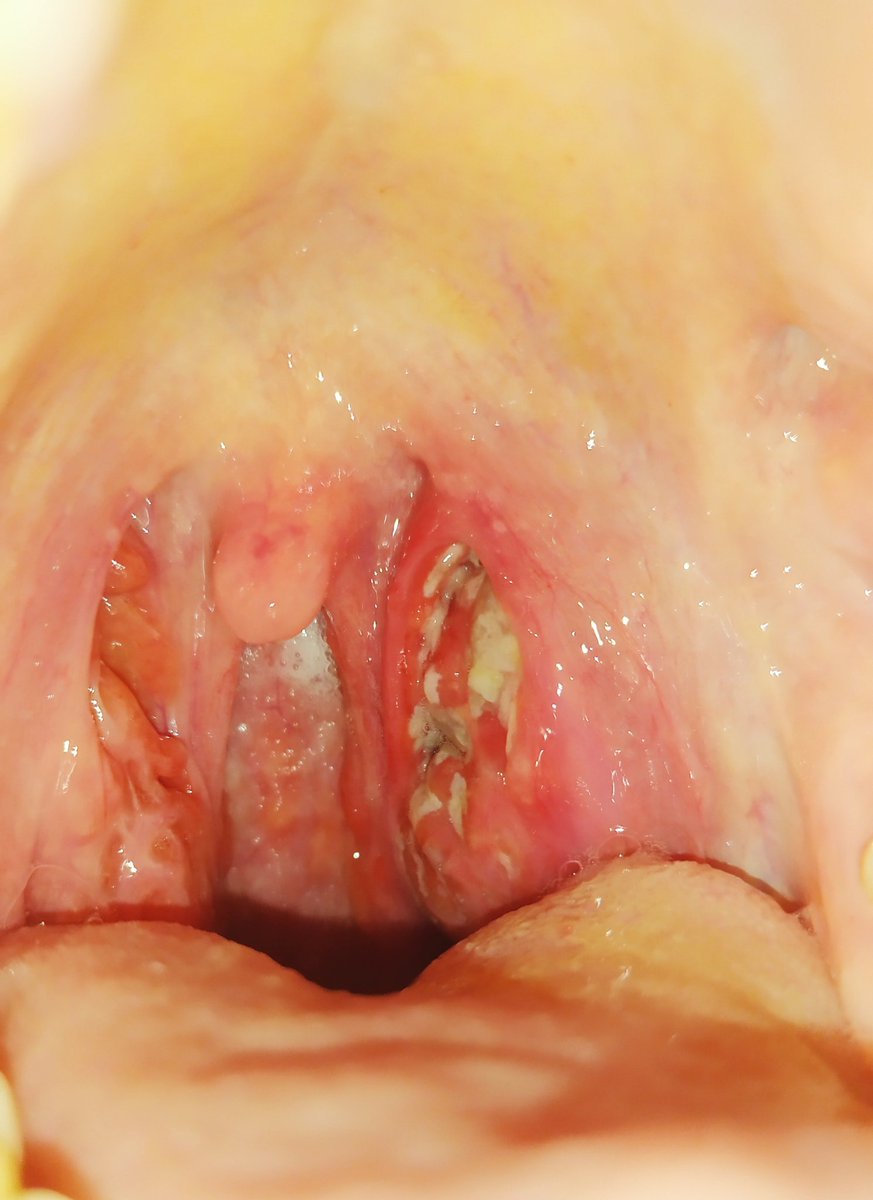 RT para que no se te infecten las amígdalas