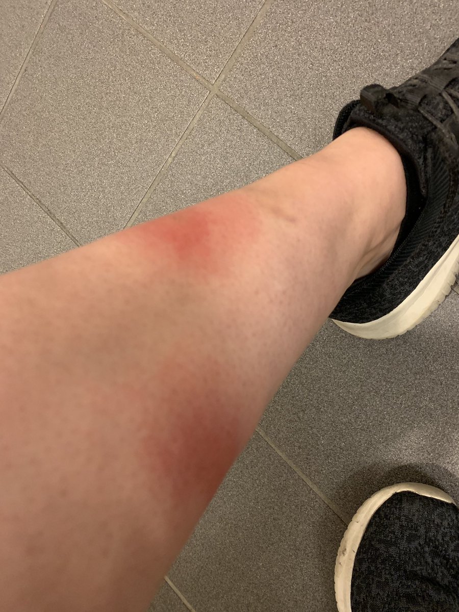 nakrissimo's tweet image. PSA: Om du blir klort av katt så du får ripe i huden: Vask etterpå. Gjerne med pyrisept. Katteklorfeber er ikke farlig, men det klør noe helt infernalsk. Hos meg dukket det opp en uke etter å ha hilst på og kost/kranglet med @OdaRygh sin übersøte #voidkitten Daemon.