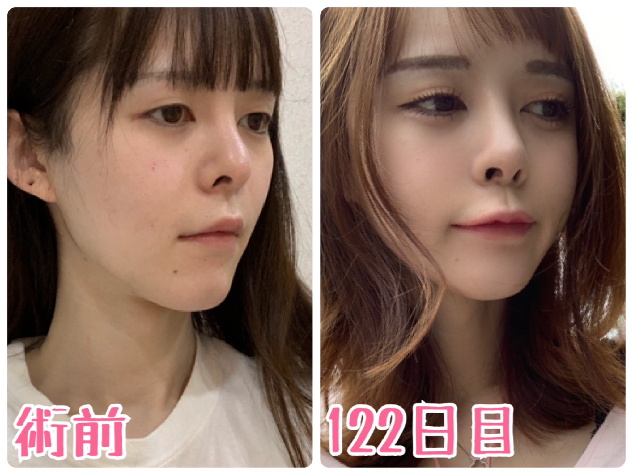 本田優花 ハニたん 術前と整形手術から122日目の比較 横顔の頬のラインが本当に滑らかになってます それと昔は頬骨 がでていたので ゴツゴツ感があったから頬骨も削ってよかった T Co G8zp0am3hv Twitter