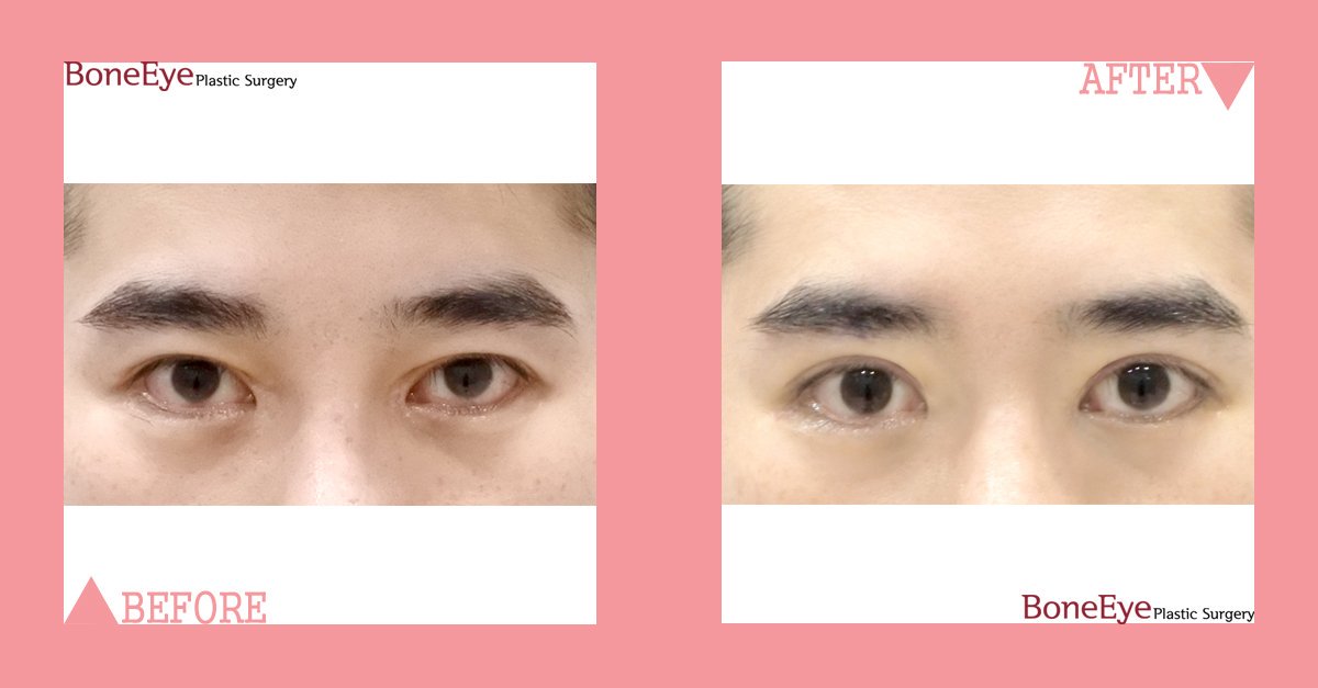 BoneeyePlastic's tweet photo. 👍 Let's see this man's case!!

✔️ Eye surgery - incision(revision), ptosis correction

#boneeye #koreanclinic #manseyes #ptosis #doubleeyelids #maxim #kpop #gangnamstyle #gangnamsquare #manup #antiaging #facelifting #facialexpression #handsomeman #chat https://t.co/34nwInP9oI