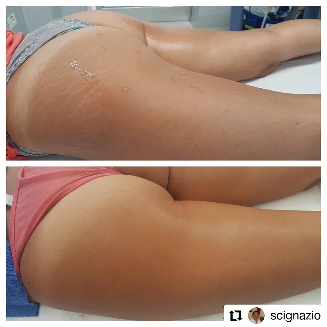IrradiaSB's tweet photo. 💫 Regenera la piel de tus pacientes y dale una nueva vida con #Biodermogenesi, un tratamiento totalmente seguro, indoloro y eficaz que consigue rellenar el surco de las #estrías y permite su #bronceado natural.

🌐 https://t.co/RMC9SNrXyd https://t.co/rMfYpIbf1N