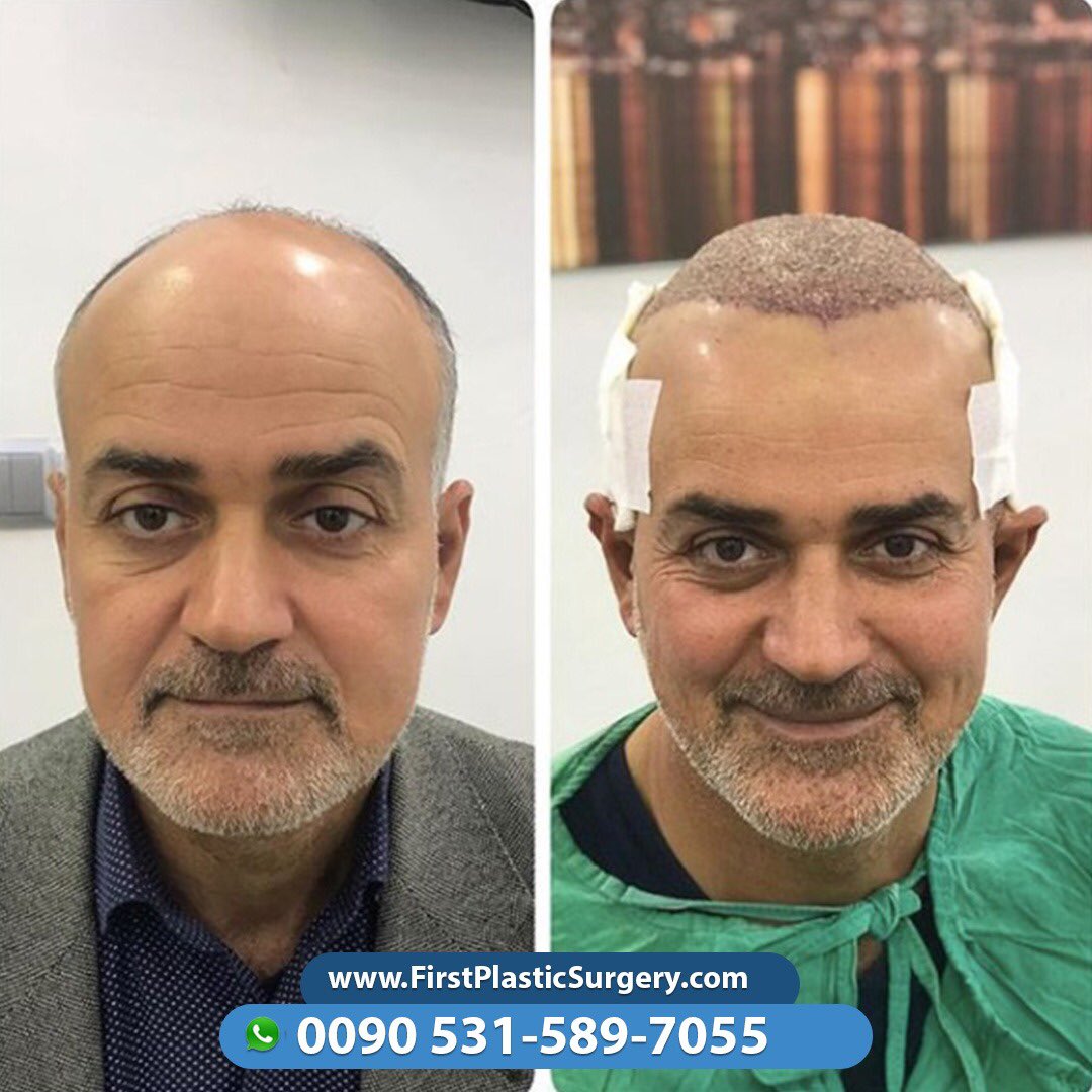CosmeticsTurkey's tweet image. 😳The impossible has become an easy reality with us☺️ Contact us via Viber/WhatsApp 🇸🇦🇹🇷🇫🇷🇬🇧🇩🇪🇳🇱
📞00905315897055 ☎
firstplasticsurgery.com
😍😍🇹🇷🇹🇷😍🇹🇷😍🇹🇷😍🇹🇷🇹🇷😍😍🇹🇷😍😍
#facelift #cosmeticsurgery #confidence #selfconfidence #antiaging #naturalresults #eastcoastplasticsurgeo