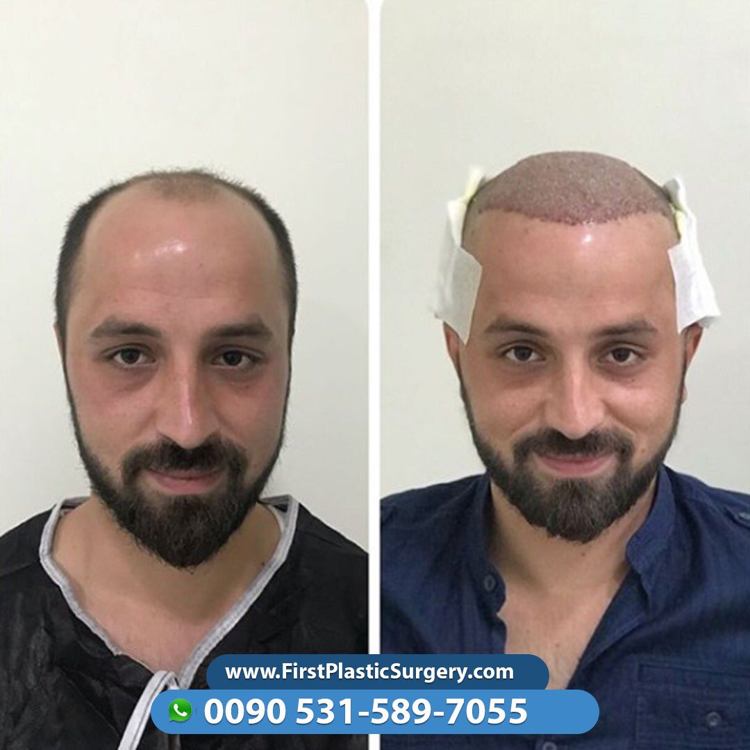 CosmeticsTurkey's tweet image. 💇🏻‍♂️Prepare your youth again with us💇🏻‍♂️ Contact us via Viber/WhatsApp 🇸🇦🇹🇷🇫🇷🇬🇧🇩🇪🇳🇱
📞00905315897055 ☎
firstplasticsurgery.com
😍😍🇹🇷🇹🇷😍🇹🇷😍🇹🇷😍🇹🇷🇹🇷😍😍🇹🇷😍😍
#facelift #cosmeticsurgery #confidence #selfconfidence #antiaging #naturalresults #eastcoastplasticsurgeon #bostonplasticsu