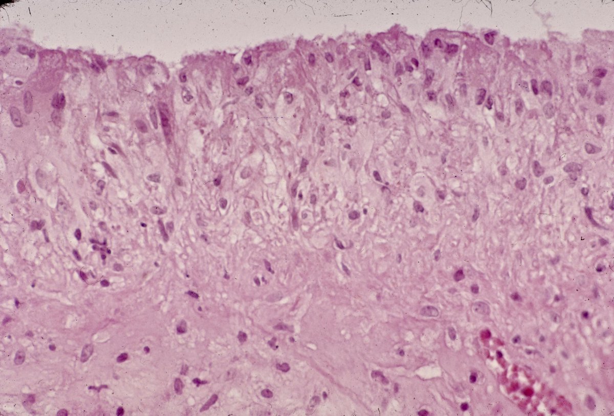 #Pleural_effusion in a patient with #rheumatoid_arthritis. Elongated histiocytes with tapered cytoplasmic processes. They may have more than one nucleus. Multinucleated giant cells. The corresponding biopsy show the elongated histiocytes surrounding a necrotic center. #CytoPath