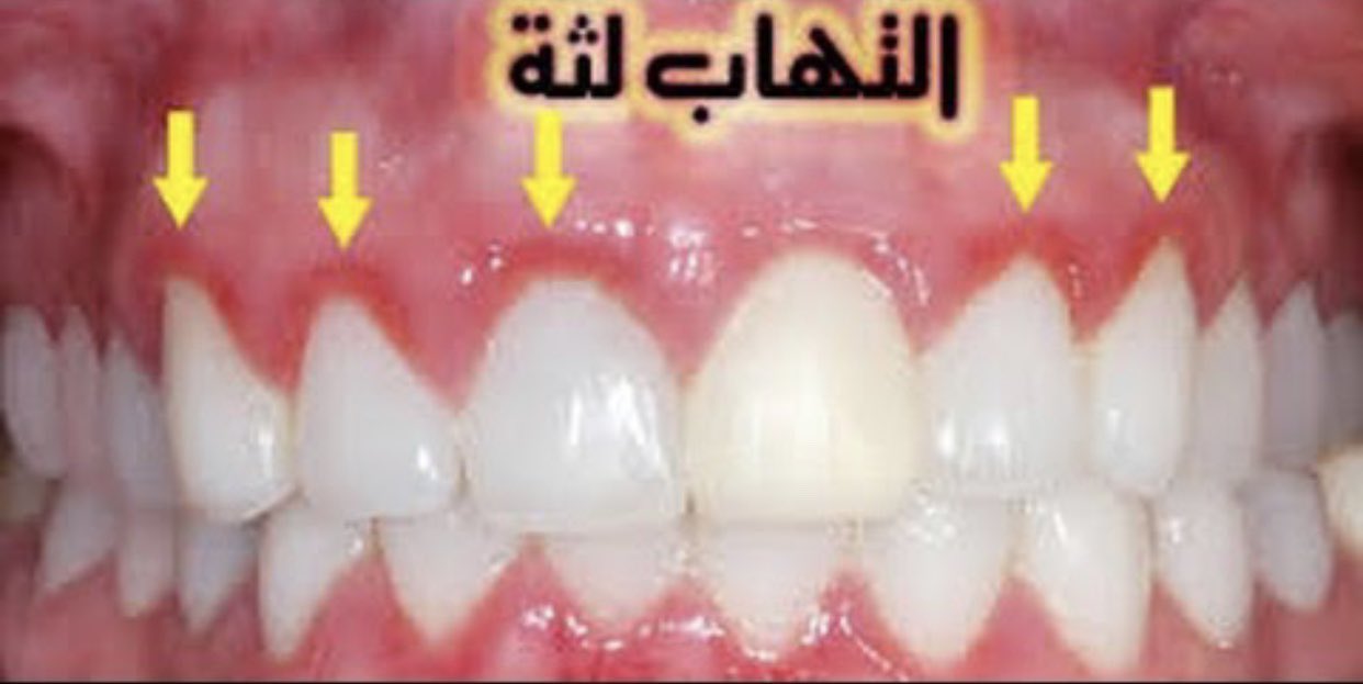 عيوب التقويم الشفاف المتحرك بنات One