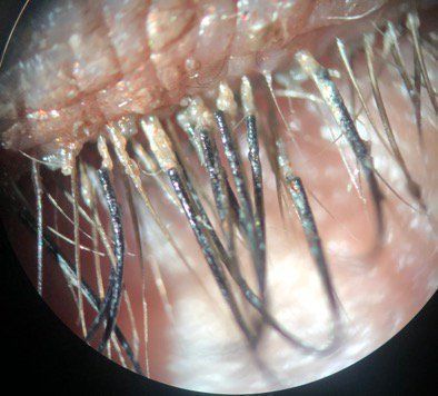 OptometryTimes's tweet photo. A case of demodex infestation with eyelash extensions. #optometry https://t.co/wob3TbDzTr https://t.co/28iiP6phRZ