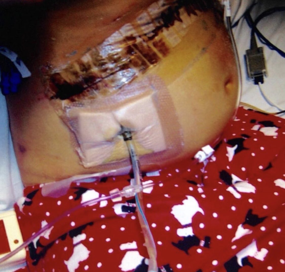 micanewcomb's tweet photo. Please share and let’s try and raise awareness together! ITS NATIONAL ORGAN WEEK! This is so close to home! Can’t stress enough the importance of organ donation I wouldn’t be here today without it! After all why cremate when you can donate! #OrganDonationWeek https://t.co/yOY3uXogna