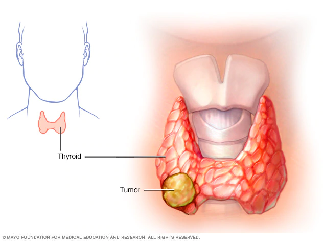 September is #ThyriodCancer awareness month, too! The thyroid is a butterfly-shaped gland that sits below your Adam’s apple, along the front of the windpipe. It secretes several hormones that influence metabolism, growth and development, and body temperature. #cancersig