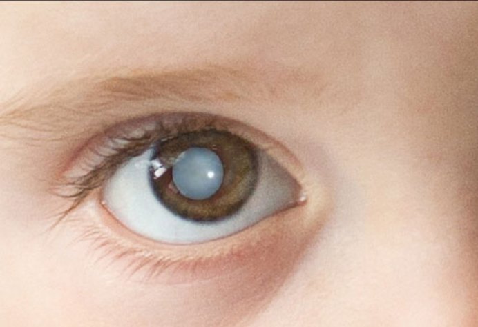 врожденный катаракта глаз. врожденный катаракта глаз. краснуха синдром врожденной краснухи. катаракта глаза у новорожденного. врожденный катаракта глаз.