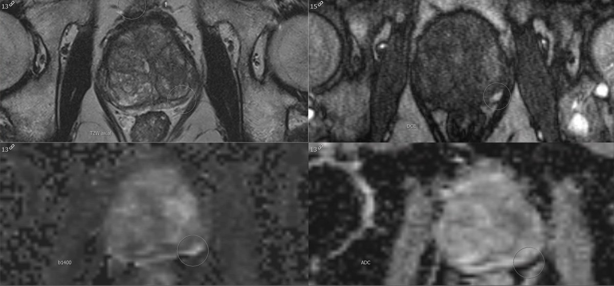 prostate mri pi rads 4