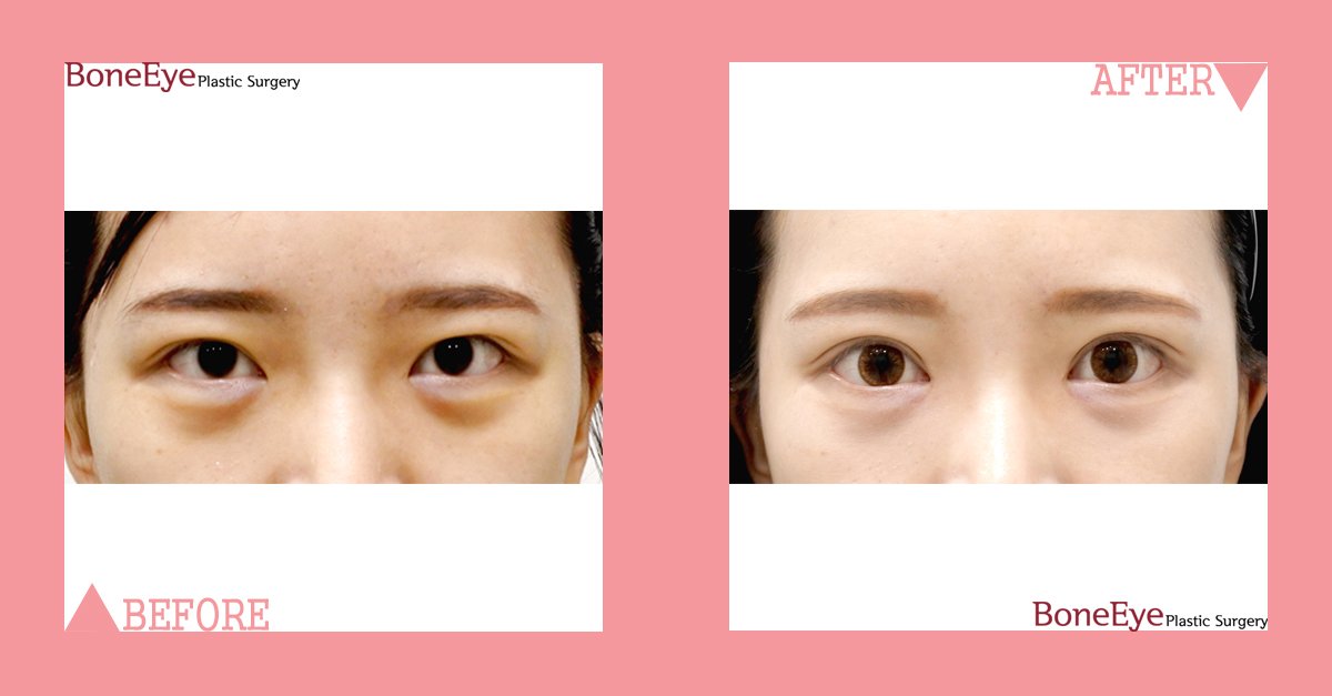 BoneeyePlastic's tweet photo. 💞 Revision cases are better healing!!

✔️ eye surgery - incision(revision), epicanthoplasty

#boneeye #doubleeyelids #koreanclinic #incision #epicanthoplasty #revision #nonincision #koreansurgeon #moonseongho #koreandoctor #facelifting #kpopstar https://t.co/JeWSWcI9ER