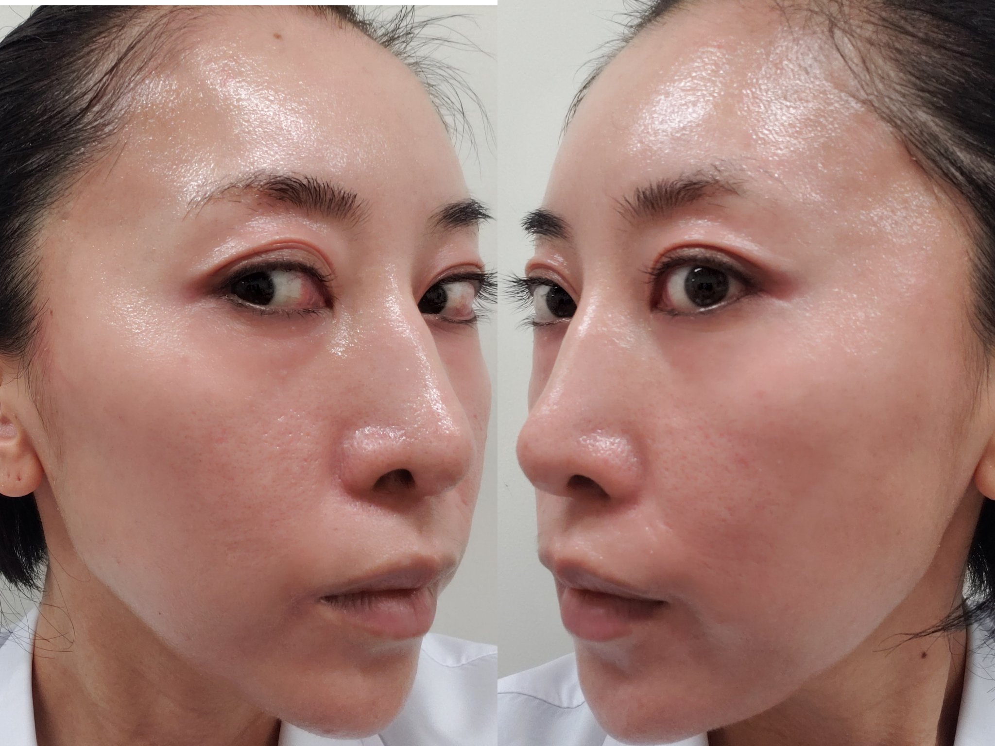 上原恵理 ちなみに ゼオスキン中で肌が敏感な私が使用してるのはドラッグストアで購入したワセリンのみ メイクもしてない 昼間は日焼け止め塗るし 痒くて仕方ないときは鎮静作用のあるイニクス使うけど イニクスに期待するのは鎮静作用と保湿だけ 上原恵理 ちなみに ゼオスキン中で肌が敏感な私が使用してるのはドラッグストアで購入したワセリンのみ メイクもしてない 昼間は日焼け止め塗るし 痒くて仕方ないときは鎮静作用のあるイニクス使うけど イニクスに期待するのは鎮静作用と保湿だけ