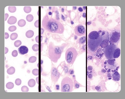 feldstej's tweet photo. #MDS #5q- #BloodCancerAwarenessMonth #heme #hemepath #pathtwitterfamily #meded #TuesdayThoughts #TuesdayMotivation #TuesdayMood #TuesdayVibes #bloodworks #ashimage https://t.co/i7ZDFB7Rmd