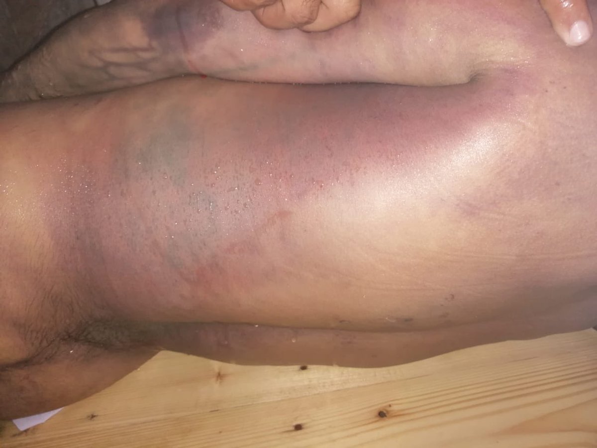 HniaziISF's tweet photo. Literally every part of the body has been tortured. How can IO AND SHO not be arrested. The case should be sent to model courts for trial. https://t.co/uaGe3nY64D