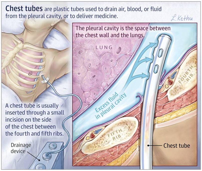 pneumothorax chest tube