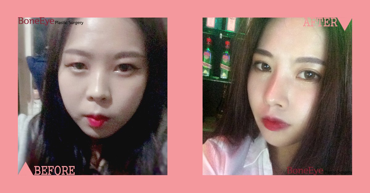 BoneeyePlastic's tweet photo. 💞 When it is done in BoneEye PS!!
✔️ eye surgery - incision(revision)
✔️ nose surgery - rhynoplasty(revision)

#2ndsurgery #revision #boneeye #koreanclinic #doubleeyelids #beautifulkorean #beautifulnose #newlife #gangnamstyle #kpop #koreangirl #koreanupdates https://t.co/G3icR8lbxp