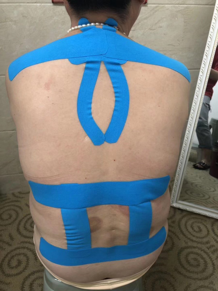 DLbandage's tweet photo. We will say the most complicated and variable symptoms appear in the waist, hope we can help you recovery from the pain.#kintape #dlbandage #kinesiologytape#TraditionalChineseBiomimeticsMedicine#TCBM https://t.co/zF91dAZWZD