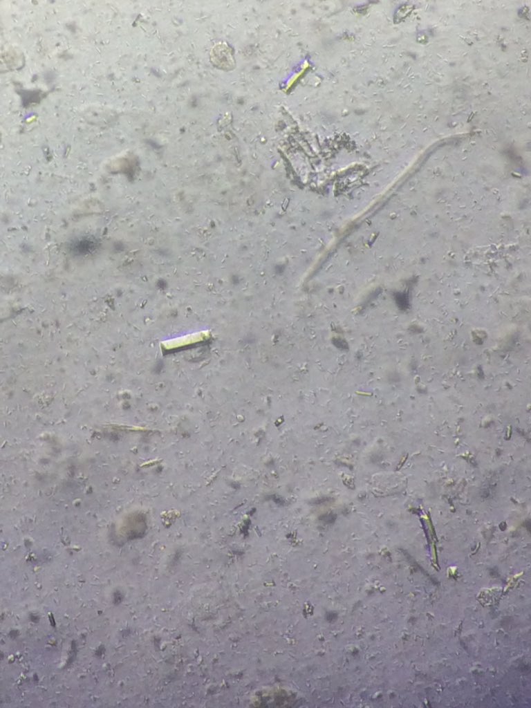 mdclninja's tweet image. Triple phosphate crystals (coffin-lid appearance) 

swear, they are beautiful under the microscope. ♥️

#LifeUnderTheMicroscope 🔬