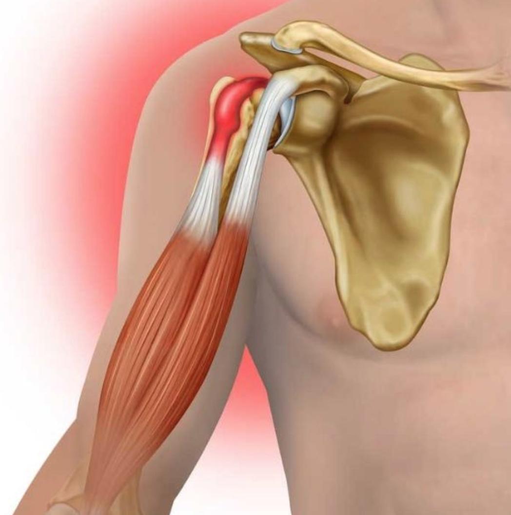 Разрыв надостного сухожилия плечевого сустава лечение. Теносиновит сухожилия длинной головки бицепса. Тендинит сухожилия бицепса. Тендинит надостной мышцы. Тендинит плечевого сустава.
