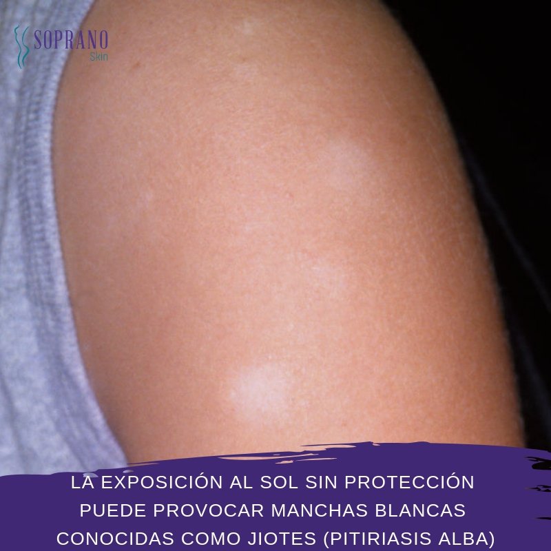 Frenesí Gaviota primero Soprano Skin on Twitter: "La exposición al sol sin protección puede  provocar manchas blancas conocidas como jiotes (pitiriasis alba). 🤓  #dermatips #manchas https://t.co/c7TyPGqxdR" / Twitter