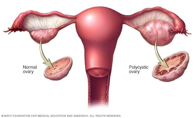 Here's a typical representation of a normal and cystic ovary. Check out the differences in presentations.